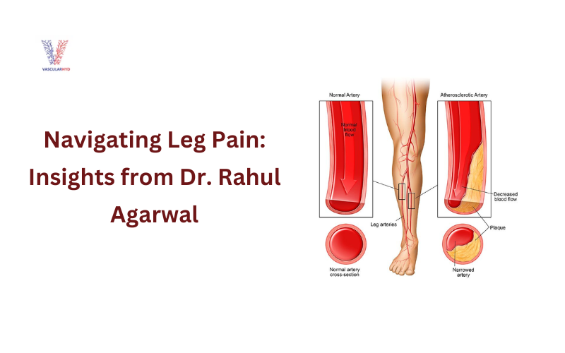 Navigating Leg Pain: Insights from Dr. Rahul Agarwal